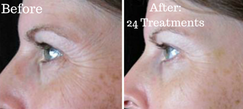 crows feet before and after